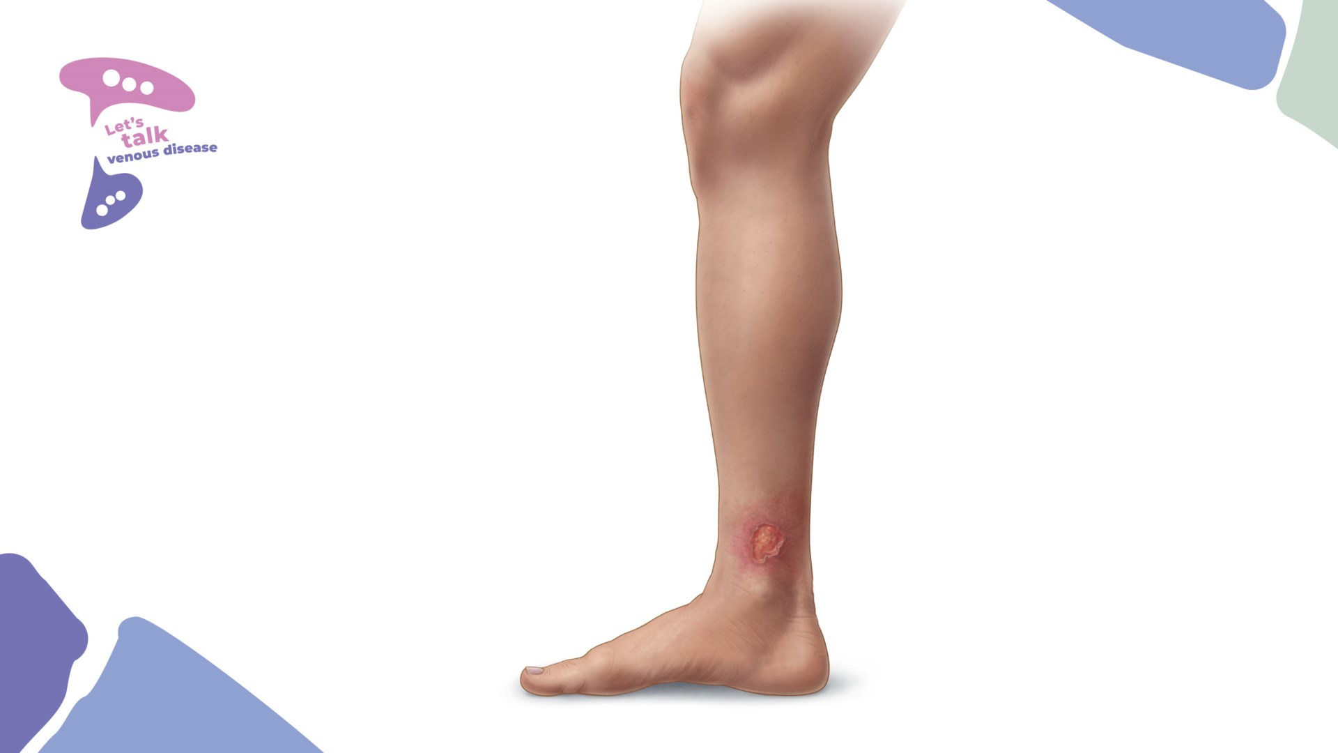 Venous leg ulcer