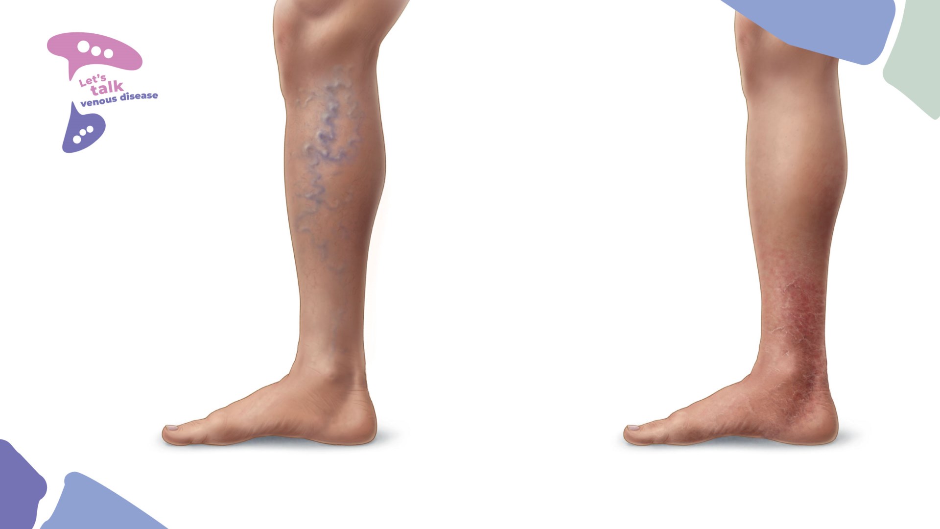 Understanding venous disorders