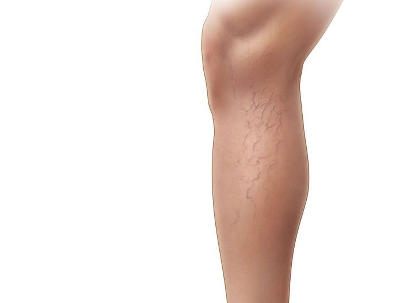 Doenças venosas crônicas (DVC) | Sigvaris.com