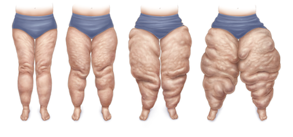 How quickly does Lipedema progress?